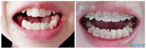 窝沟封闭手调和光固化的区别与窝沟封闭光固化的时间，问题锦集(图1)